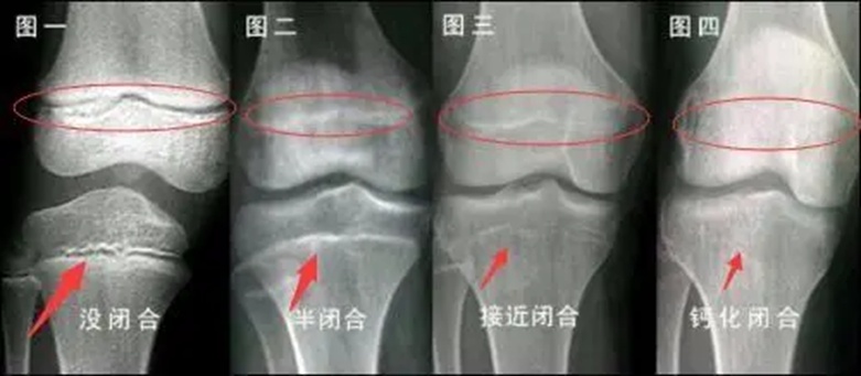 警惕!这些信号预示孩子“停止生长”(图6) 警惕!这些信号预示孩子“停止生长”(图6)